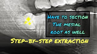 When the Mesial Root is Stuck Step by Step Wisdom Tooth Extraction Video with Instruments Listed [upl. by Joris]