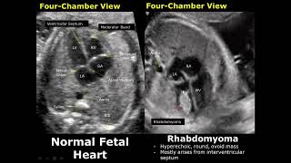 Echogenic Focus EIF Definition Causes Treatment [upl. by Arymat]