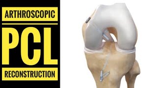 Arthroscopic PCL Posterior Cruciate LigamentReconstruction with Hamstring Graft [upl. by Donall]