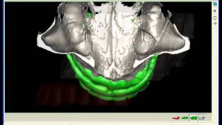 SimPlant  Dual Scan versus Single Scan [upl. by Leahplar]