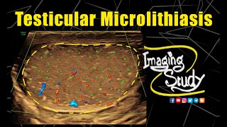 Testicular Microlithiasis  Ultrasound  Case 334 [upl. by Lanny]