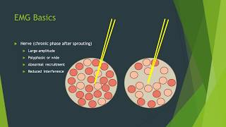 Neuropathy vs myopathy on EMG [upl. by Sigismund]