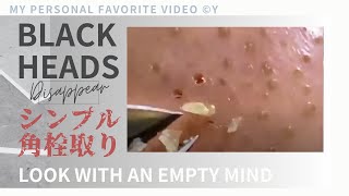 This is a simple video of removing blackheads from the nose using tweezers  3 hours シンプル角栓除去長時間動画 [upl. by Sholem]