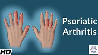 Psoriatic Arthritis Causes Signs and Symptoms Diagnosis and Treatment [upl. by Ybrik627]