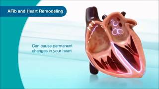 What is Atrial Fibrillation AFib This Video Explains It [upl. by Hindorff]