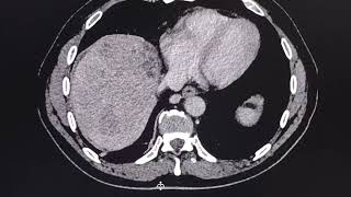 Acute liver  hepatic  failure CT findings [upl. by Amik]