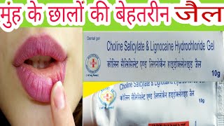 Choline Salicylate amp Lignocaine Hydrochloride Uses in Hindi [upl. by Bannerman723]