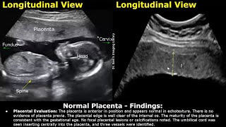 Placenta Ultrasound Reporting  How To Write Pregnancy USG Reports  Pathologies amp Positions Scans [upl. by Camilia281]