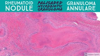 Rheumatoid Nodule amp Granuloma Annulare Palisaded Necrobiotic Granuloma Pattern Dermatopathology [upl. by Aicatsana]