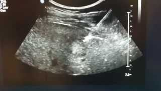 ULTRASOUNDGUIDED LIVER BIOPSY [upl. by Atiuqes365]