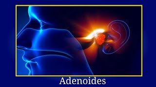 Adenoides Que Es  Los Adenoides Como Detectarlas Consecuencias y Tratamiento [upl. by Eerdna]