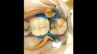 Restoring that broken molar and the difficult class II cavity [upl. by Llenyt86]