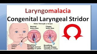 ENT 348 a Laryngomalacia congenital laryngeal stridor inspiratory [upl. by Ihsorih]