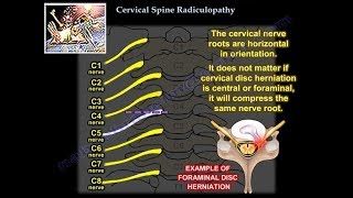 Cervical Radiculopathy  Everything You Need To Know  Dr Nabil Ebraheim [upl. by Stewart509]