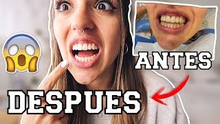 🔥 MI EXPERIENCIA CON EL BLANQUEAMIENTO DENTAL 😰 ¿ME DOLIO ¿PRECIO [upl. by Erfert]