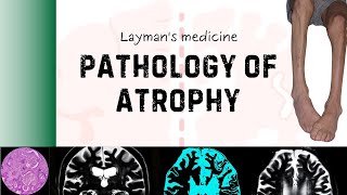 Atrophy  Pathology made fun [upl. by Nomead]