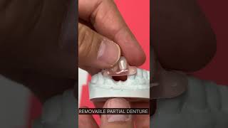 REMOVABLE PARTIAL DENTURE dentist [upl. by Mike]