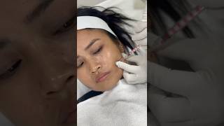 Best Botox treatment for face in India [upl. by Nayt]