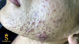 Dr Lee Removes This Patient’s Second Head Growing On His Neck  Dr Pimple Popper [upl. by Ahsitahs796]