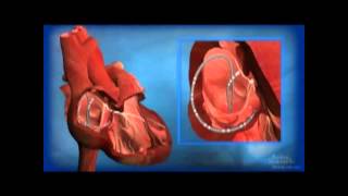 Ablation for AV Node Reentrant Tachycardia AVNRT [upl. by Anyrb]