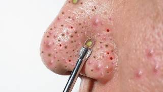 ACNE REMOVAL  Pimple Popping  SATISFYING Blackhead amp Whitehead Extraction [upl. by Erreipnaej]