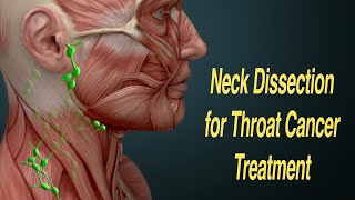 Neck Dissection Surgery for Throat Cancer Treatment MRND RND [upl. by Beatty]