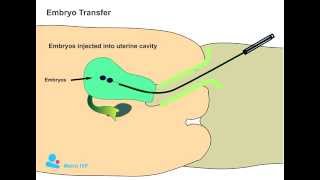 Embryo Transfer procedure [upl. by Yssak]