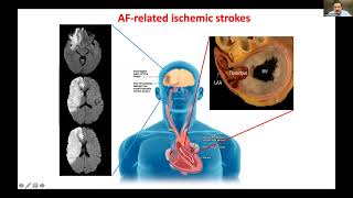 WSA Webinar  Cerebral Amyloid Angiopathy ICH and Afib Stroke Prevention Approaches [upl. by Rochemont]