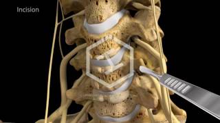 c5c6c7 Anterior Cervical Discectomy with Fusion [upl. by Eltotsira27]