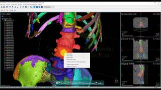 OOOPDS  Surgical planning for a spinal puncture （Vertebroplasty） [upl. by Hilary]