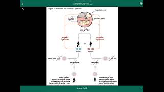 Kallmann Syndrome  متلازمة كولمان [upl. by Eleinad]