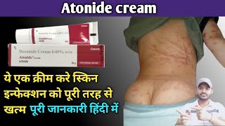 Atonide cream 005 use dose benefits and side effects full review in hindidesonide cream [upl. by Alaunnoif]