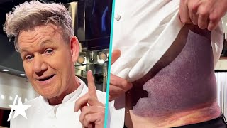 Gordon Ramsay Reveals MASSIVE Bruise After Bike Accident [upl. by Herv701]