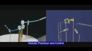 Cardiac Ablation Catheter Precision and Reach with Stereotaxis RMN [upl. by Vatsug173]