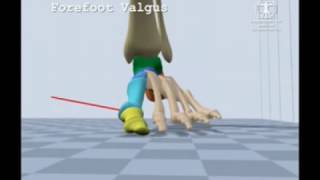 Forefoot Valgus Gait [upl. by Wager]