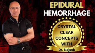 Epidural Hemorrhage  Anatomical  Features amp Pathophysiology  Dr Najeeb [upl. by Hayse]