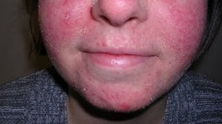 How to Treat Facial Eczema DermTVcom Epi 479 [upl. by Tsnre]