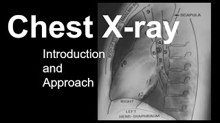 Chest Xray Introduction and Approach [upl. by Annabela773]