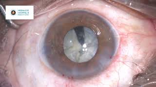 Mature Cataract Phacoemulsification  Small Pupil Phaco  Dr Ashish K Jain  MEHRC Mumbai [upl. by Anyak34]