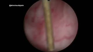 Prostatic Utricle Cyst [upl. by Admana]