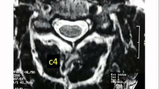 Spine Lecture How to Read a Cervical MRI [upl. by Ydnab]