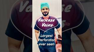 Varicose Veins  Largest Perforator  Clinical Examination Tayyabriazch [upl. by Lazar]