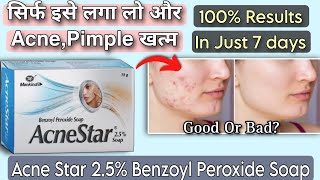 AcneStar 25 Benzoyl Peroxide Soap Good Or Bad  Get Rid Of Pimples in just 7 days acne [upl. by Hyacinth865]