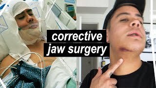 Corrective Jaw Surgery Changed My Life The Truth About My Orthognathic Procedure  JairWoo [upl. by Nezam]