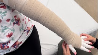 Arm bandaging for left arm lymphedema Part 2 See part 1 for the fingers [upl. by Nomled537]