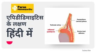 Epididymitis Symptoms Causes and Treatment  Epididymitis Homeopathy Medicine  Paras Homeopathy [upl. by Setarcos]