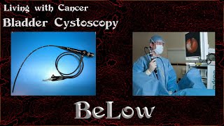 Bladder Cancer Cystoscopy [upl. by Barnie]