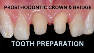 Principles of Tooth Preparation in FPD [upl. by Tilford]