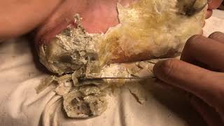 How to removal skin  callus removal skin flakes 53 [upl. by Weidman]