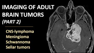 Imaging of brain tumors part 2 CNSlymphoma meningioma schwannoma and sellar tumors [upl. by Sutton816]